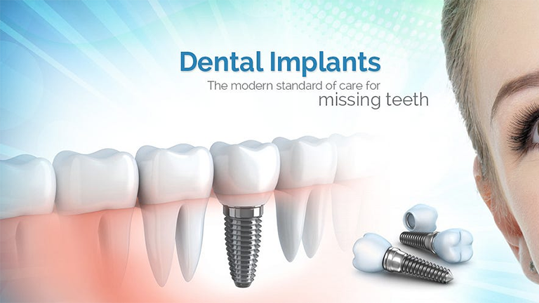 Why Dental Implants Are the Best Solution for Missing Teeth
