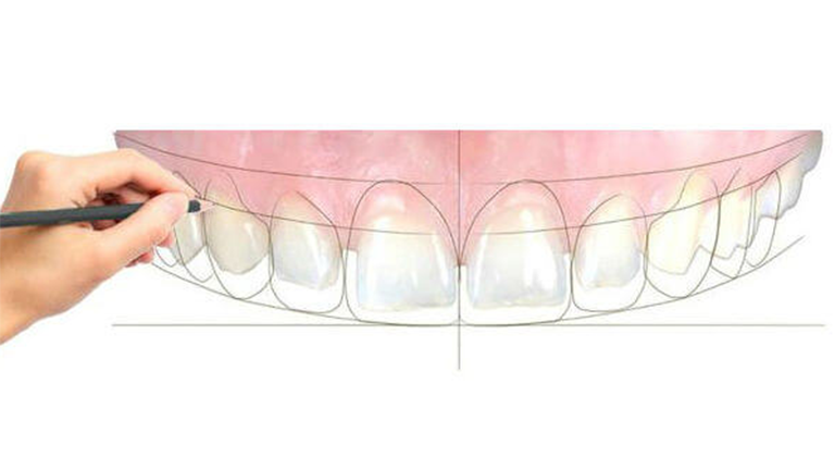 From Veneers to Braces: Factors Affecting the Cost of Dental Design