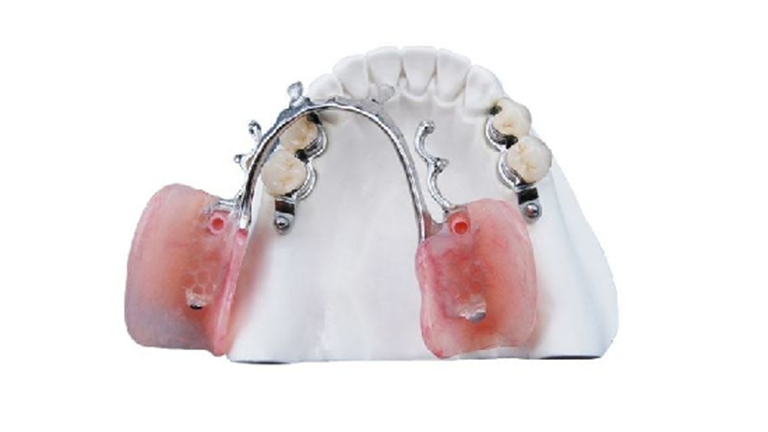 Precision Attachment: A Revolutionary Solution to Improve Bite Strength and Stability