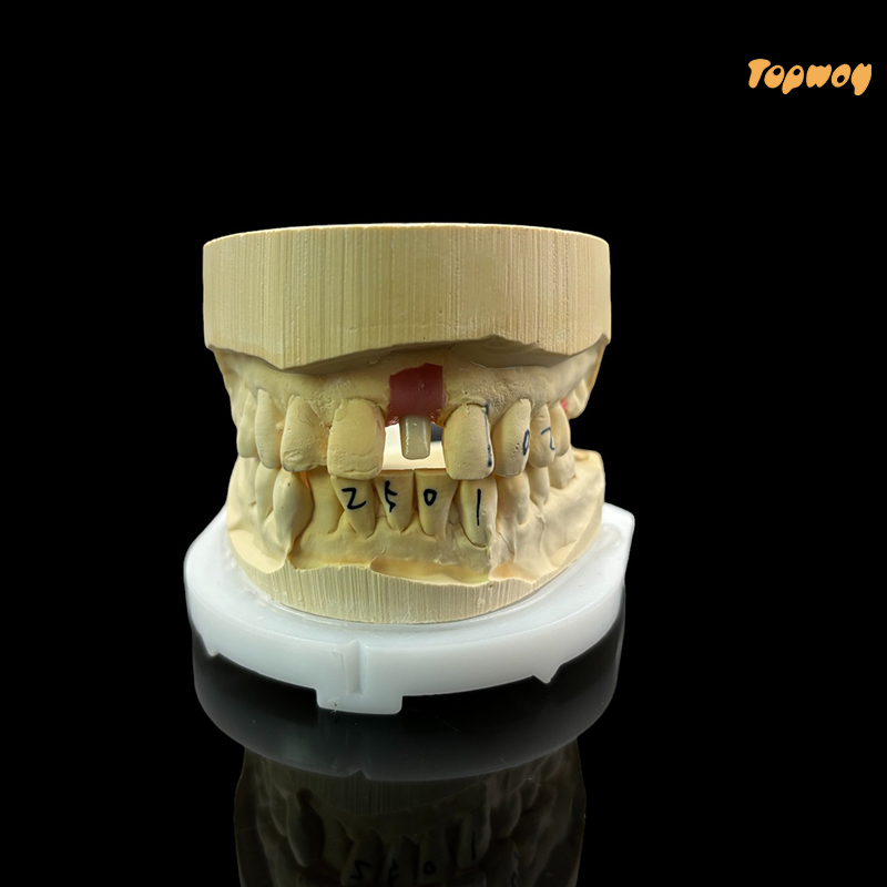 Full Metal Crown | Crown & Bridge | Products | TopWay Dental Lab China