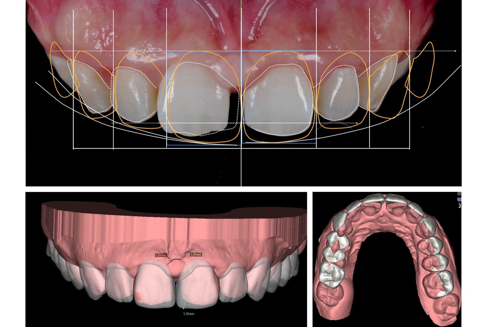 Digital Emax Veneer