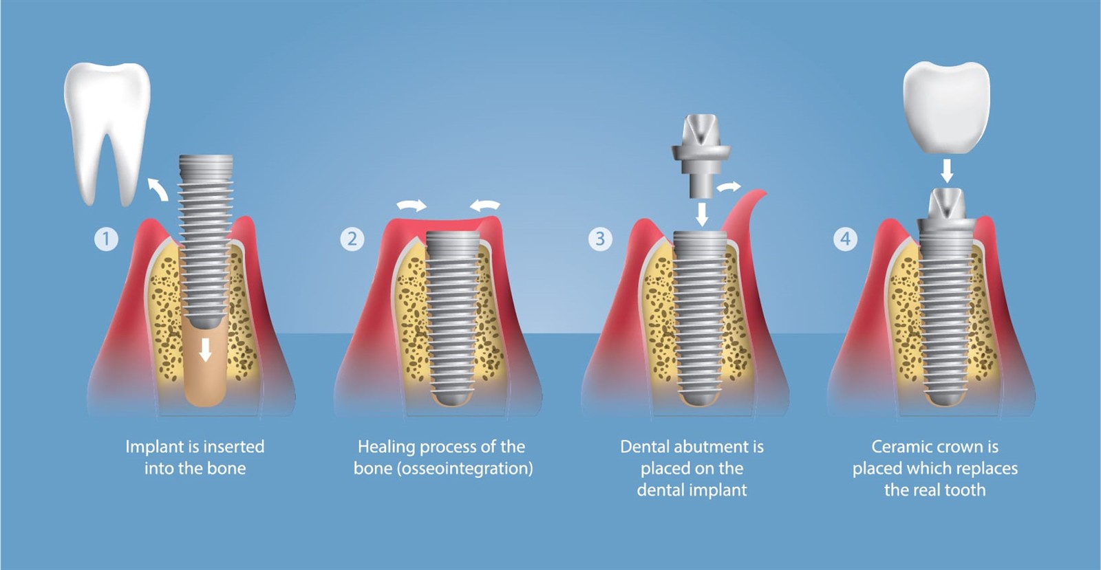 implants