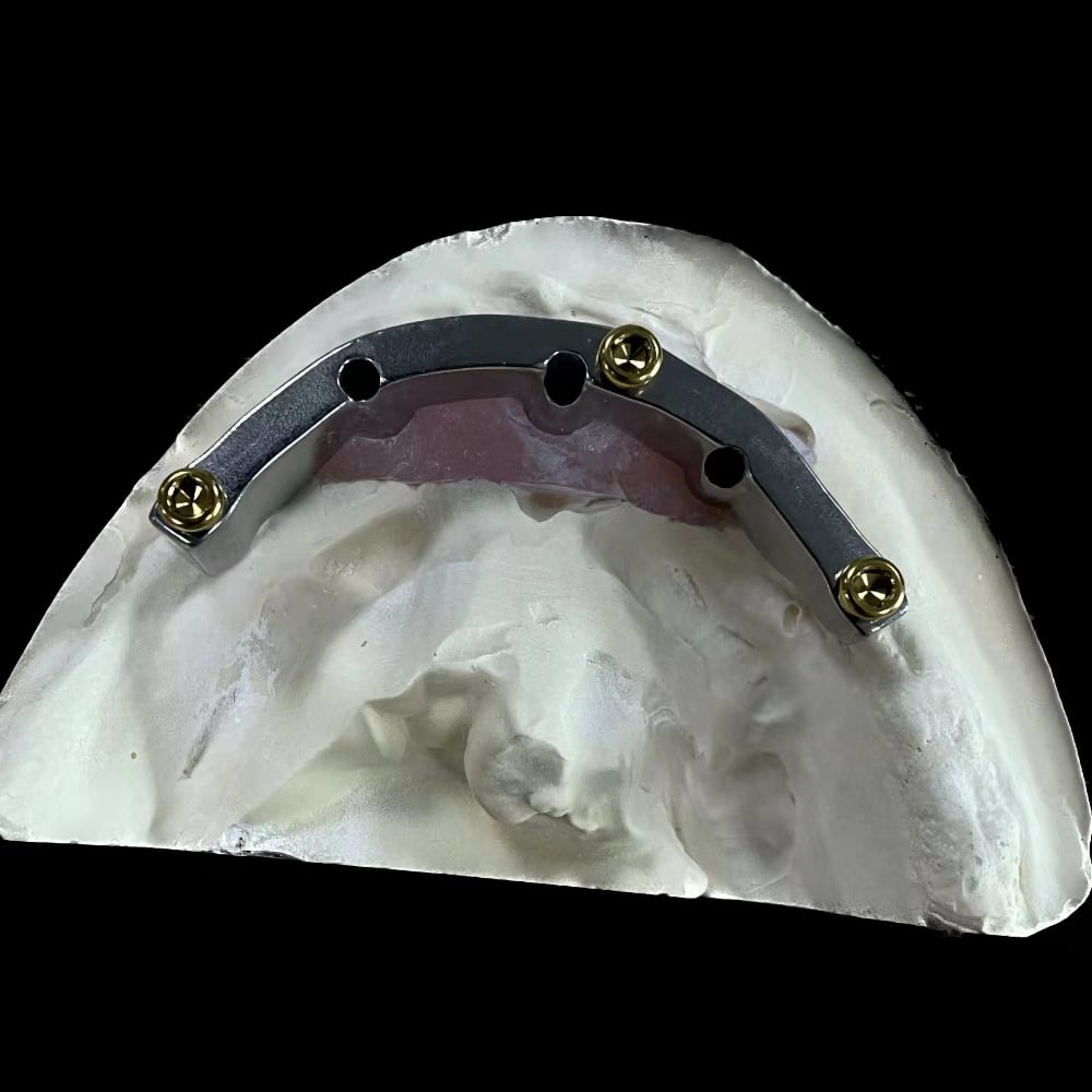 Implant Supported Dentures With Locators