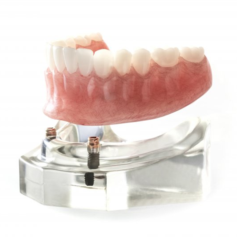 Implant Supported Dentures With Locators