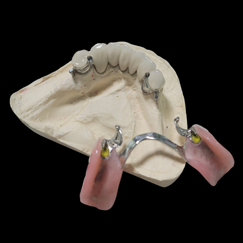 Ball Attachment With Denture