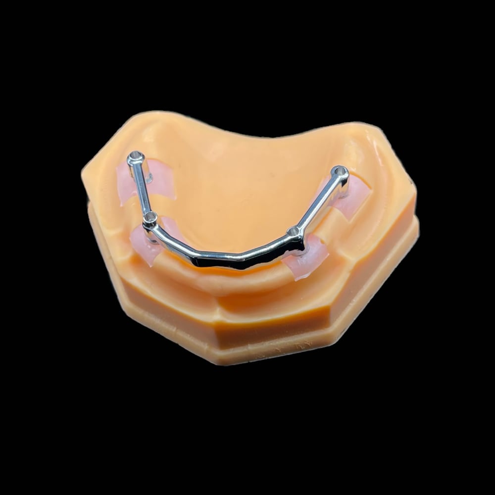Hybrid Denture With Titanium Bar