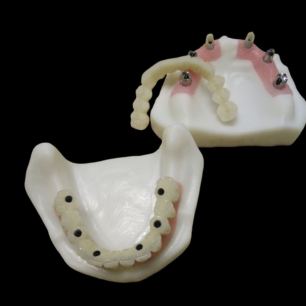 Dental Implant Screw retained Crown and Bridge